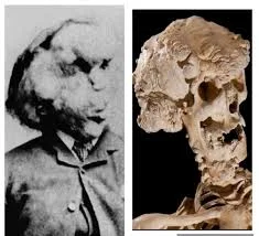 Unbelievable Revelation: The Elephant Man’s Dark Life Exposed – Joseph Merrick’s Shocking Legacy in 1862!