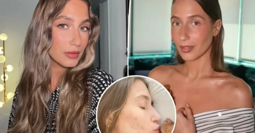 Amanda Batula Breaks the Beauty Illusion: The Truth About Her Acne Battle and What Finally Worked